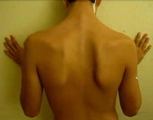 Behold: scapular dysfunction